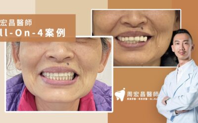 全口植牙負擔重_周宏昌醫師ALL ON 4案例