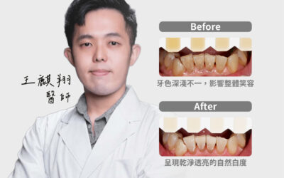 【冷光美白｜改善牙色不均的自然亮白】