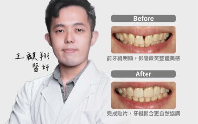 【陶瓷貼片｜自然修飾牙縫的精緻改變】