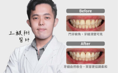 【陶瓷貼片｜正中門牙比例微調】