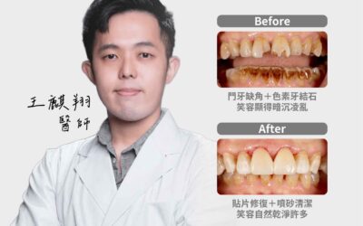 【陶瓷貼片／噴砂美白｜修復門牙讓笑容升級】