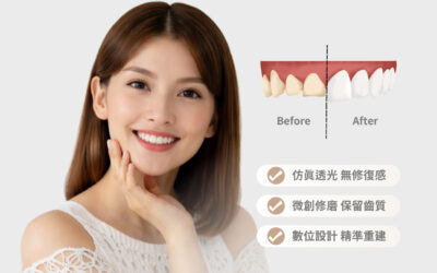 【陶瓷貼片｜門牙缺角重塑完美齒型】