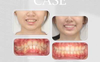 【暴牙矯正案例分享】兩年改善嘴凸與臉型|齒顎矯正專科醫師解析