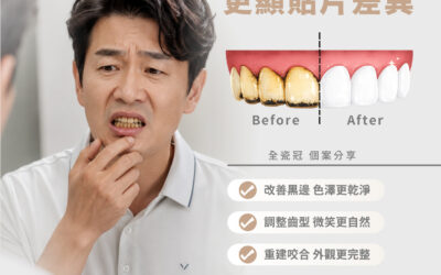 【全瓷冠|長期抽菸 更顯貼片差異】